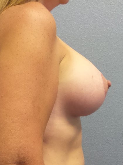 Breast Lift with Implant (Augmentation Mastopexy) Before & After Patient #998