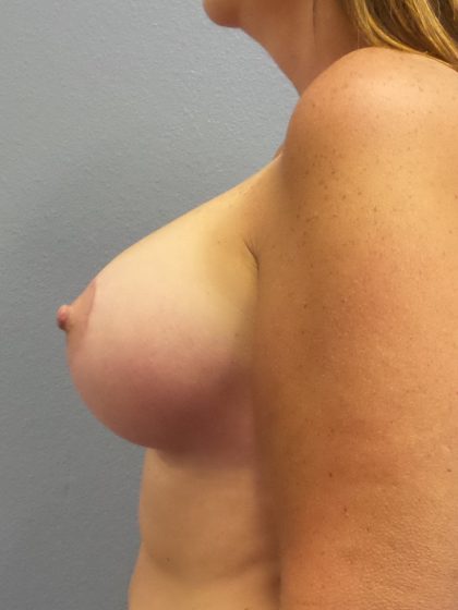 Breast Lift with Implant (Augmentation Mastopexy) Before & After Patient #998