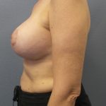 Mastopexy (Breast Lift) Before & After Patient #792