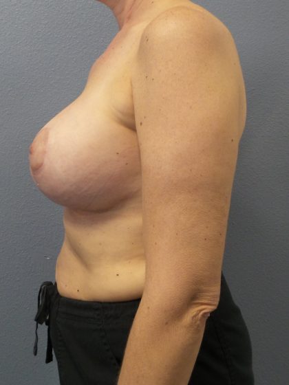 Mastopexy (Breast Lift) Before & After Patient #792