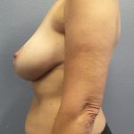 Mastopexy (Breast Lift) Before & After Patient #792