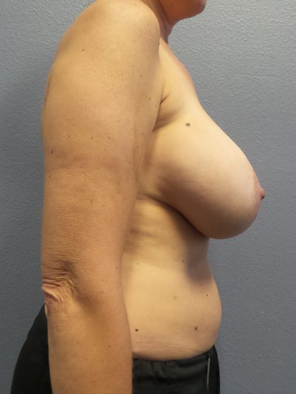 Mastopexy (Breast Lift) Before & After Patient #792
