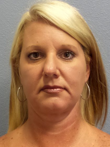 Liposuction of the Neck Before & After Patient #453