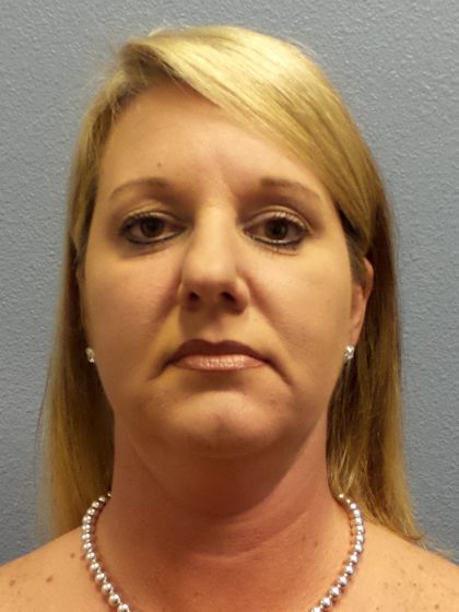 Liposuction of the Neck Before & After Patient #453