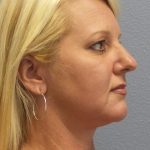Liposuction of the Neck Before & After Patient #453