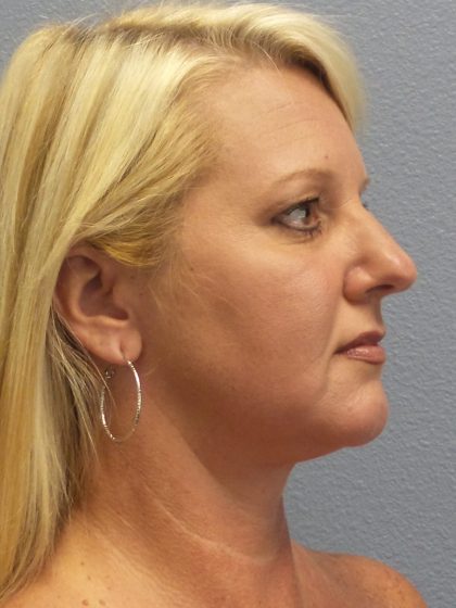 Liposuction of the Neck Before & After Patient #453