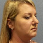 Liposuction of the Neck Before & After Patient #453