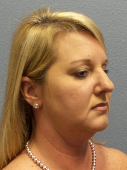 Liposuction of the Neck Before & After Patient #453