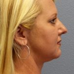 Liposuction of the Neck Before & After Patient #453