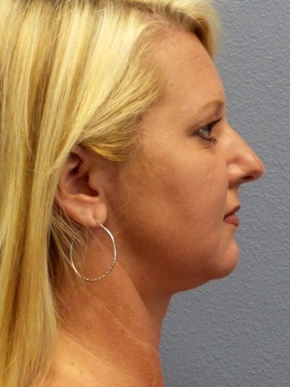 Liposuction of the Neck Before & After Patient #453