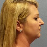 Liposuction of the Neck Before & After Patient #453