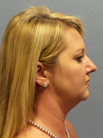 Liposuction of the Neck Before & After Patient #453