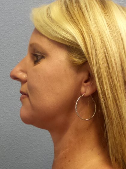 Liposuction of the Neck Before & After Patient #453