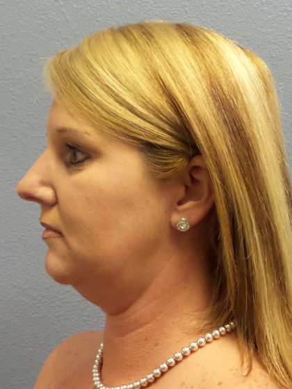 Liposuction of the Neck Before & After Patient #453