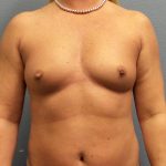 Asymmetric (Uneven) Breasts Before & After Patient #1444