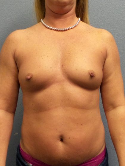 Asymmetric (Uneven) Breasts Before & After Patient #1444