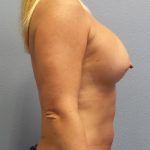 Asymmetric (Uneven) Breasts Before & After Patient #1444