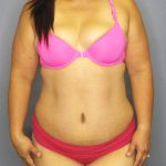 Abdominoplasty Before & After Patient #2208