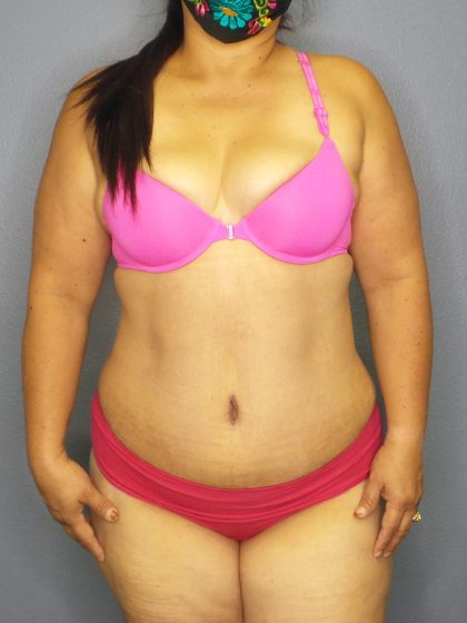 Abdominoplasty Before & After Patient #2208