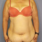 Abdominoplasty Before & After Patient #2208