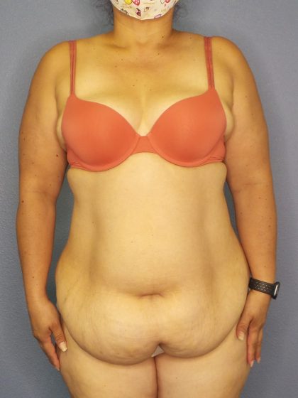 Abdominoplasty Before & After Patient #2208