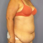 Abdominoplasty Before & After Patient #2208