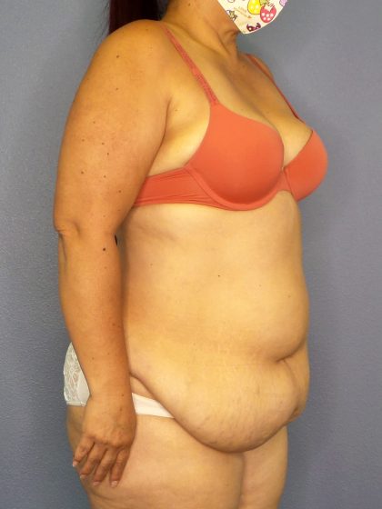 Abdominoplasty Before & After Patient #2208