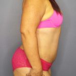 Abdominoplasty Before & After Patient #2208