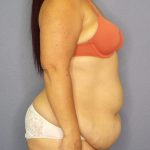 Abdominoplasty Before & After Patient #2208
