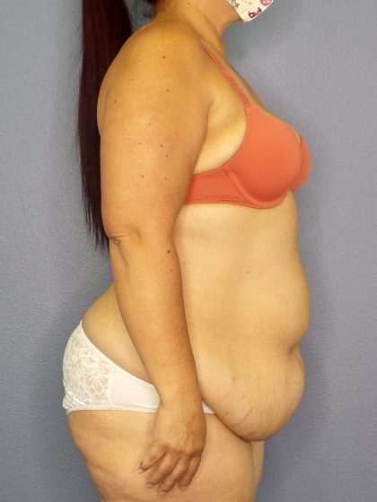 Abdominoplasty Before & After Patient #2208
