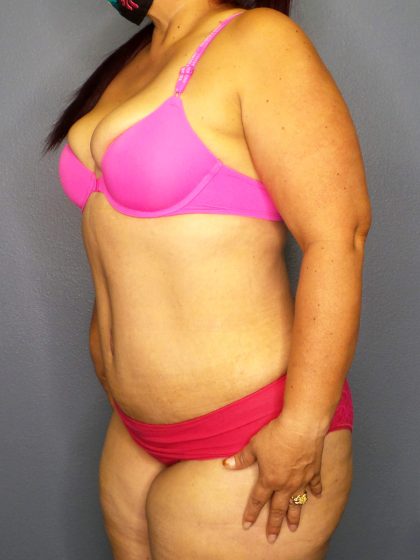 Abdominoplasty Before & After Patient #2208