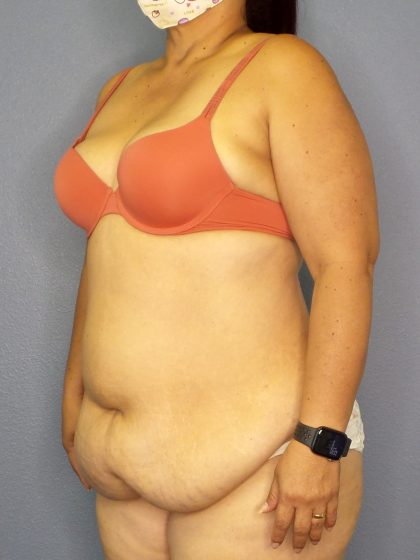 Abdominoplasty Before & After Patient #2208