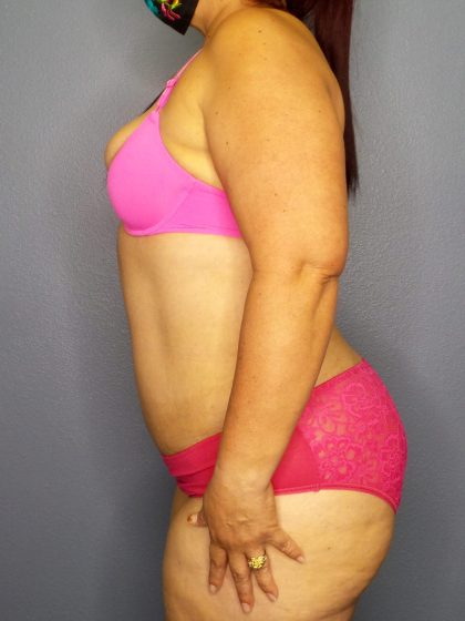 Abdominoplasty Before & After Patient #2208