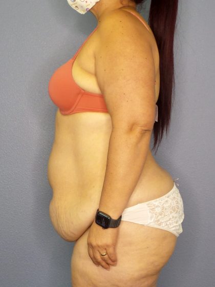 Abdominoplasty Before & After Patient #2208