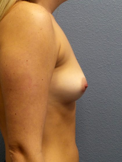Breast Augmentation Before & After Patient #1618