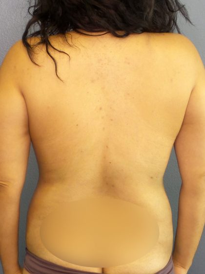 Mommy Makeover Before & After Patient #1935