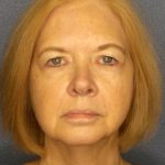 Blepharoplasty Before & After Patient #1265