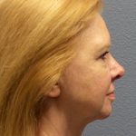 Blepharoplasty Before & After Patient #1265