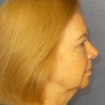 Blepharoplasty Before & After Patient #1265
