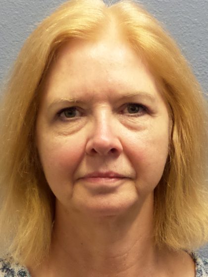 Liposuction of the Neck Before & After Patient #424