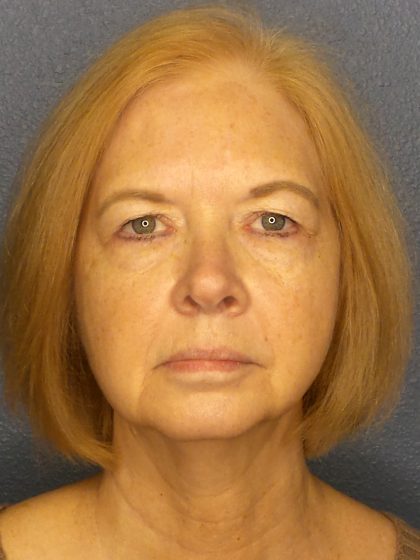 Liposuction of the Neck Before & After Patient #424