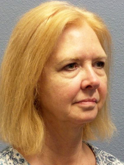 Liposuction of the Neck Before & After Patient #424