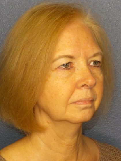 Liposuction of the Neck Before & After Patient #424