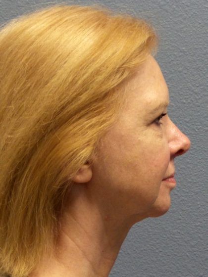 Liposuction of the Neck Before & After Patient #424