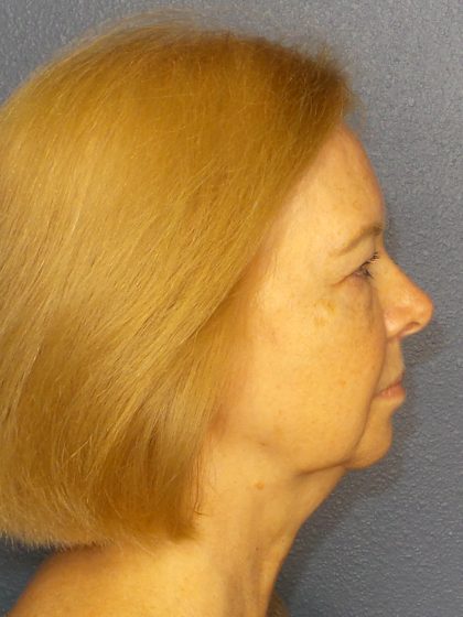 Liposuction of the Neck Before & After Patient #424