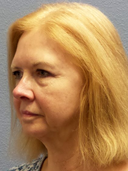 Liposuction of the Neck Before & After Patient #424