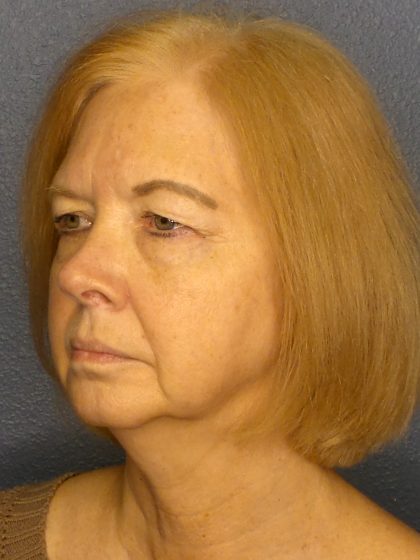 Liposuction of the Neck Before & After Patient #424