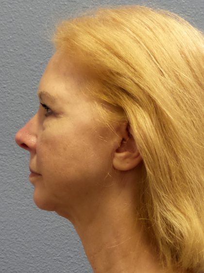 Liposuction of the Neck Before & After Patient #424