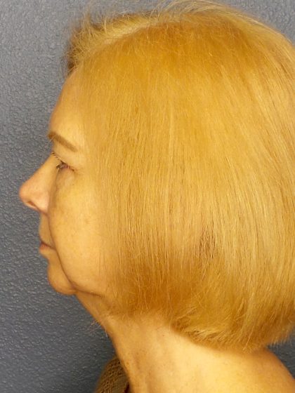 Liposuction of the Neck Before & After Patient #424