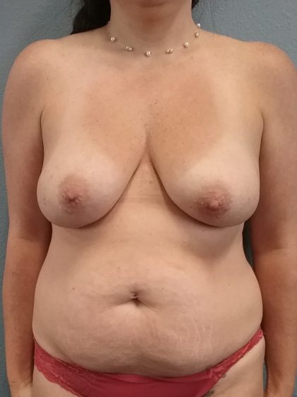 Mommy Makeover Before & After Patient #1982